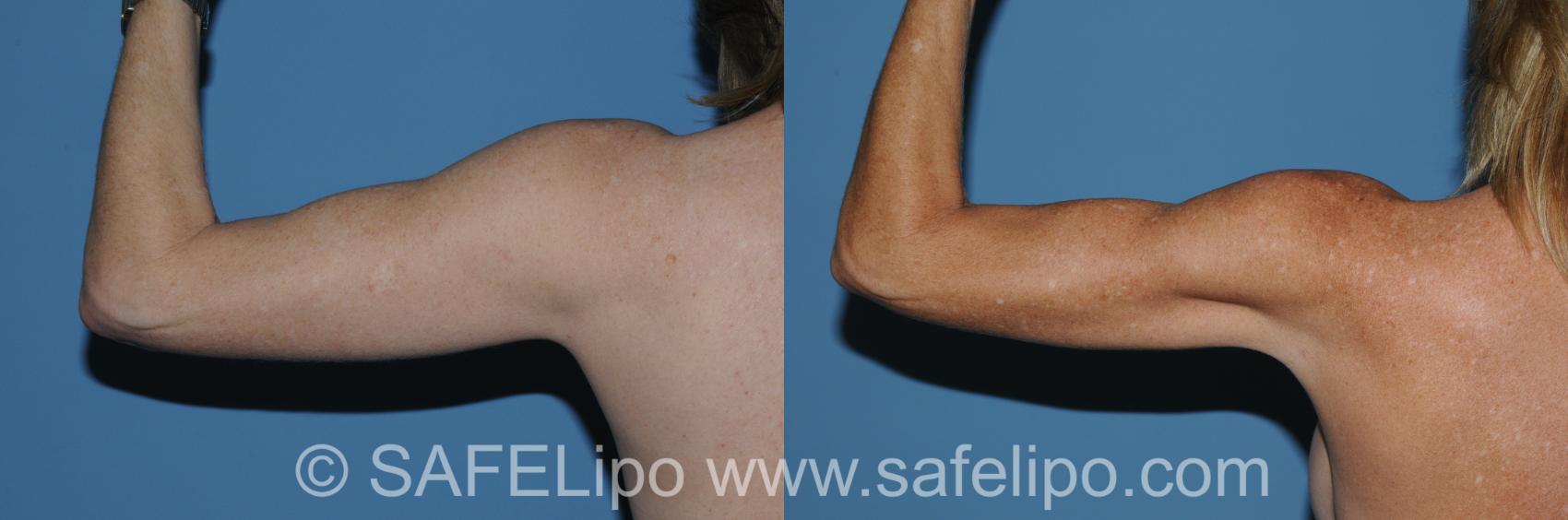 SAFELipo Back Left Flexed Photo, Shreveport, LA, The Wall Center for Plastic Surgery, Case 296