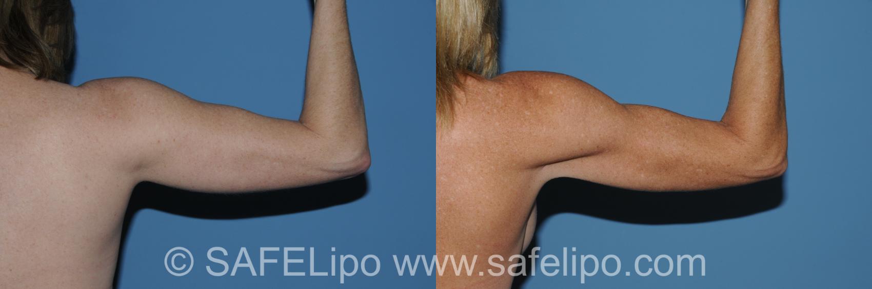 SAFELipo Back Right Flexed Photo, Shreveport, LA, The Wall Center for Plastic Surgery, Case 296