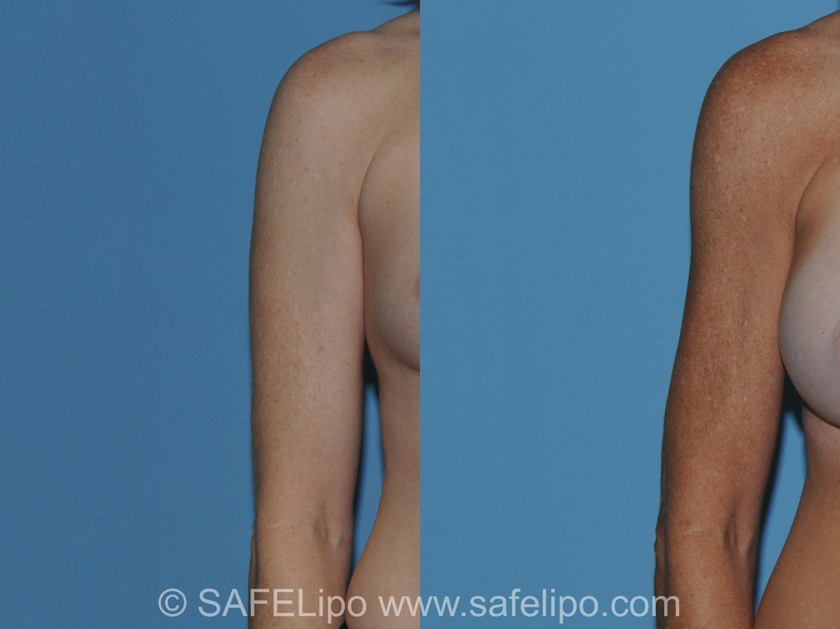SAFELipo Front Right Photo, Shreveport, Louisiana, The Wall Center for Plastic Surgery, Case 296