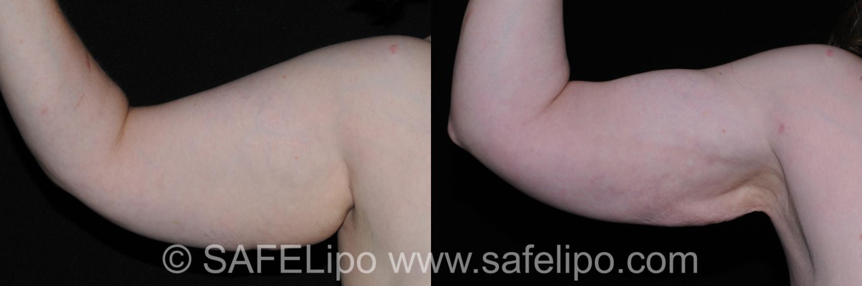 SAFELipo Front Right Photo, Shreveport, Louisiana, The Wall Center for Plastic Surgery, Case 297