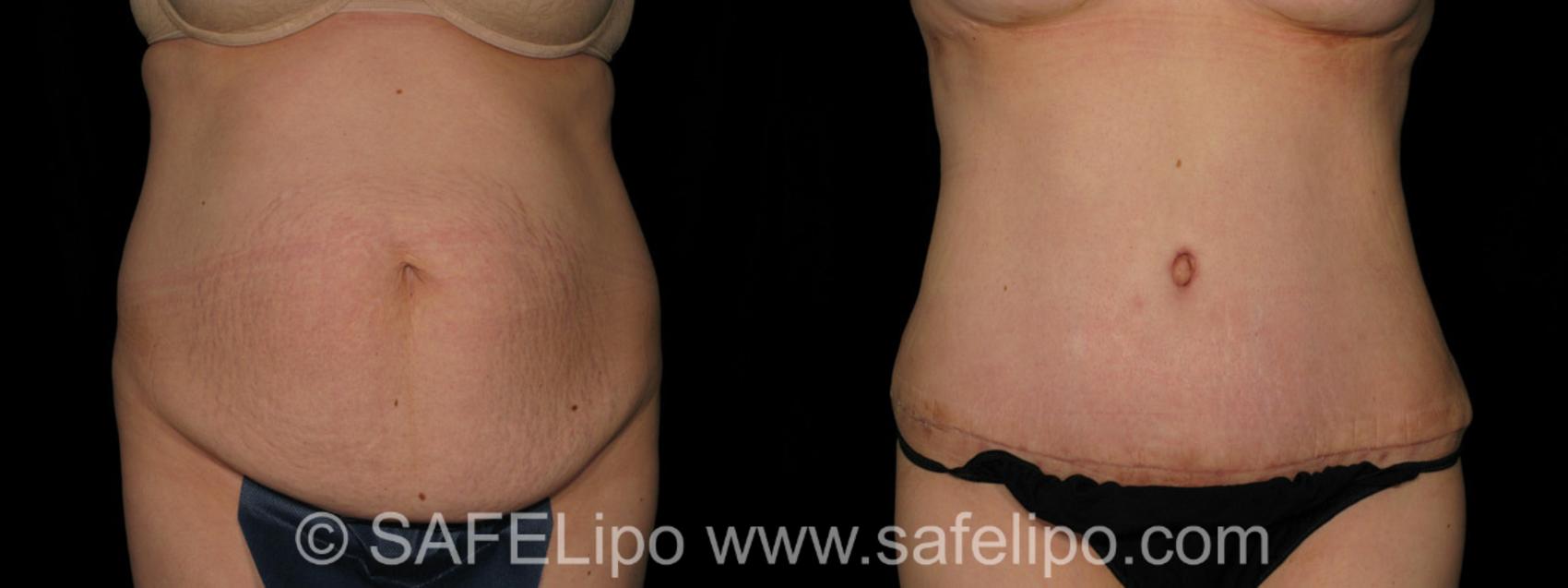 SAFELipo®360 Case 299 Before & After View #1 | SAFELipo®