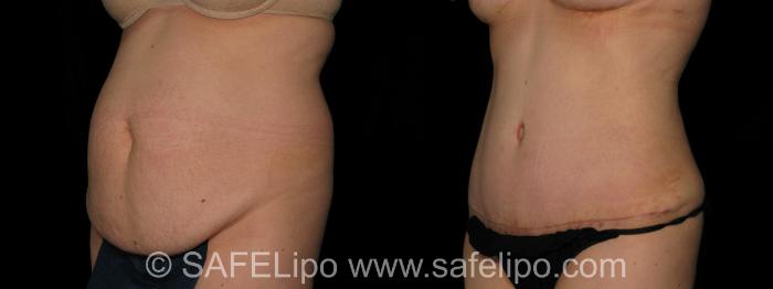 SAFELipo®360 Case 299 Before & After View #2 | SAFELipo®