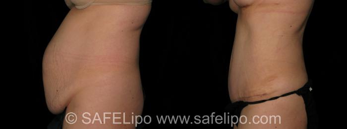 SAFELipo®360 Case 299 Before & After View #3 | SAFELipo®