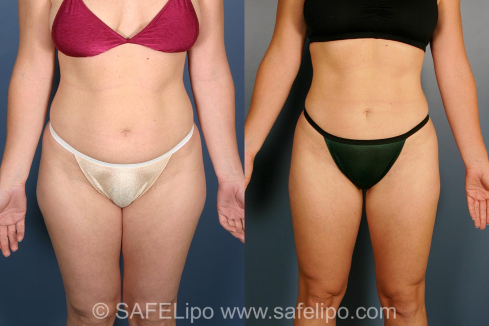SAFELipo®360 Case 301 Before & After View #1 | SAFELipo®