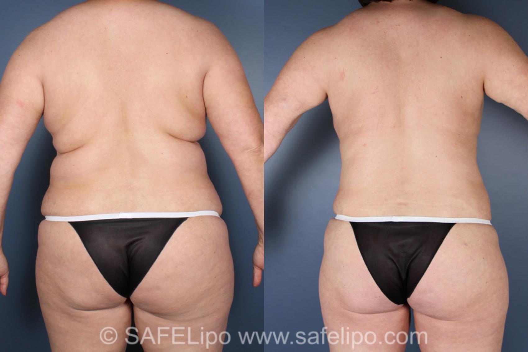 SAFELipo®360 Case 304 Before & After View #1 | SAFELipo®