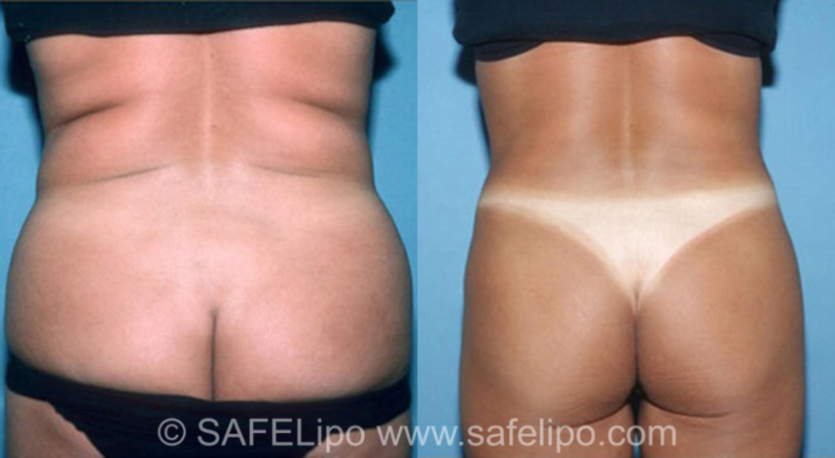SAFELipo®360 Case 310 Before & After View #1 | SAFELipo®