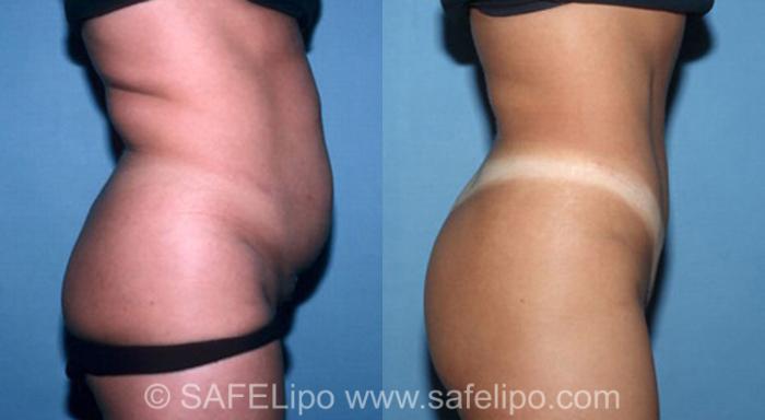 SAFELipo®360 Case 310 Before & After View #2 | SAFELipo®