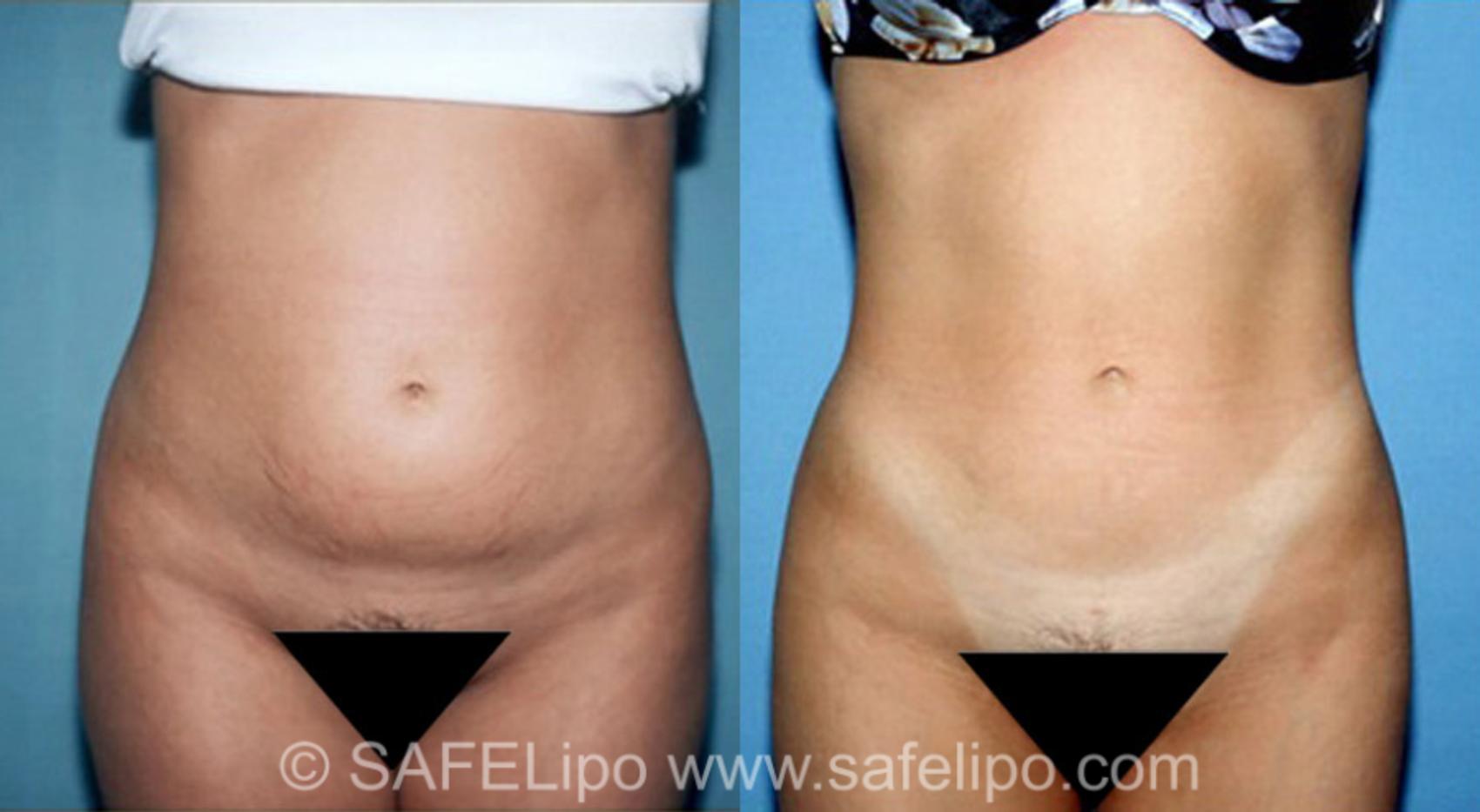 SAFELipo®360 Case 311 Before & After View #1 | SAFELipo®