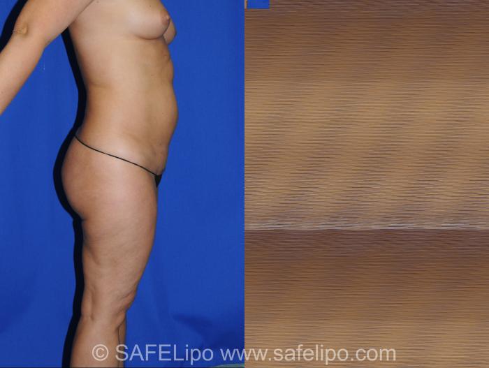 SAFELipo Right Side Photo, Shreveport, Louisiana, The Wall Center for Plastic Surgery, Case 339