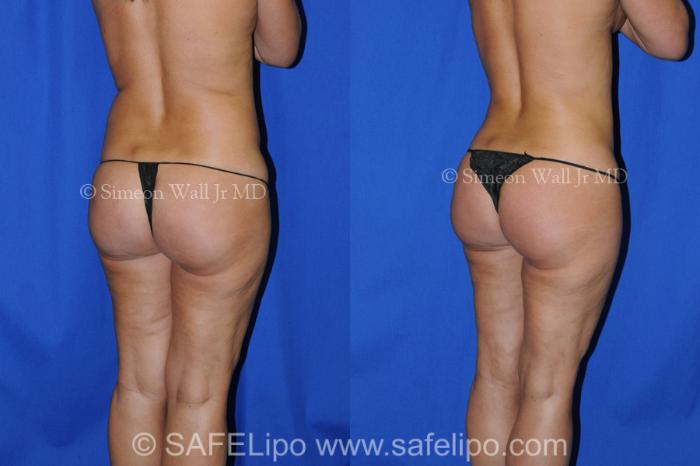 SAFELipo®360 Case 339 Before & After View #5 | SAFELipo®