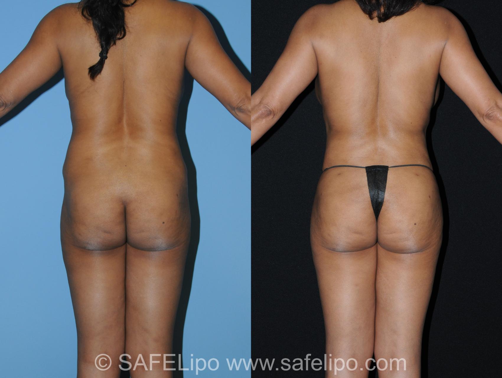 SAFELipo Back Photo, Shreveport, Louisiana, The Wall Center for Plastic Surgery, Case 343