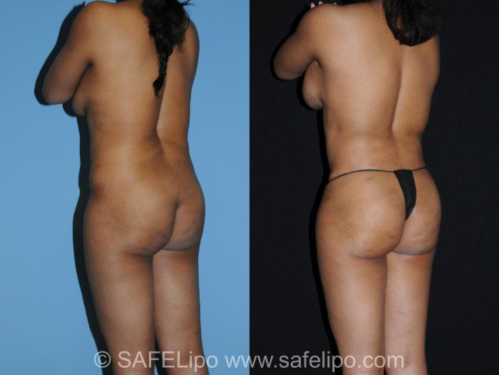 SAFELipo Back Left Oblique Photo, Shreveport, LA, The Wall Center for Plastic Surgery, Case 343