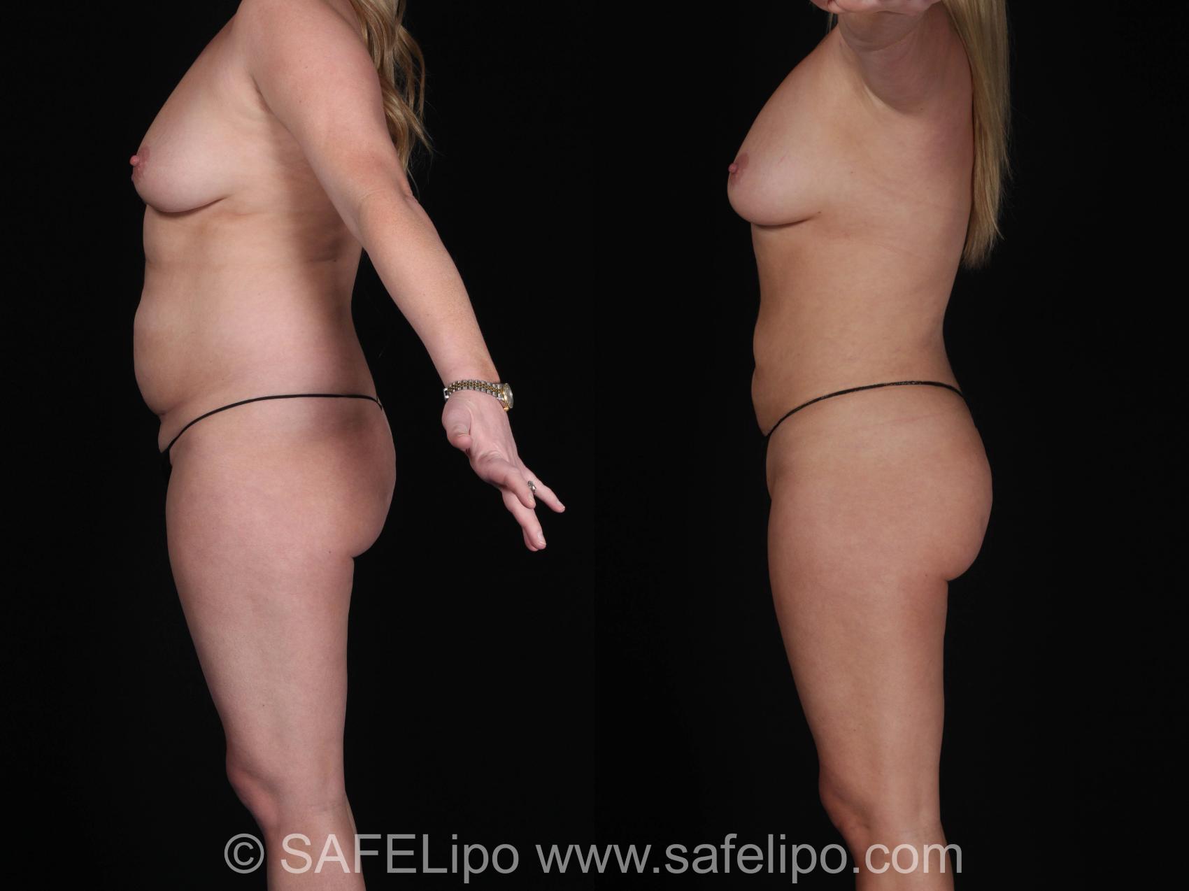 SAFELipo®360 Case 453 Before & After View #3 | SAFELipo®
