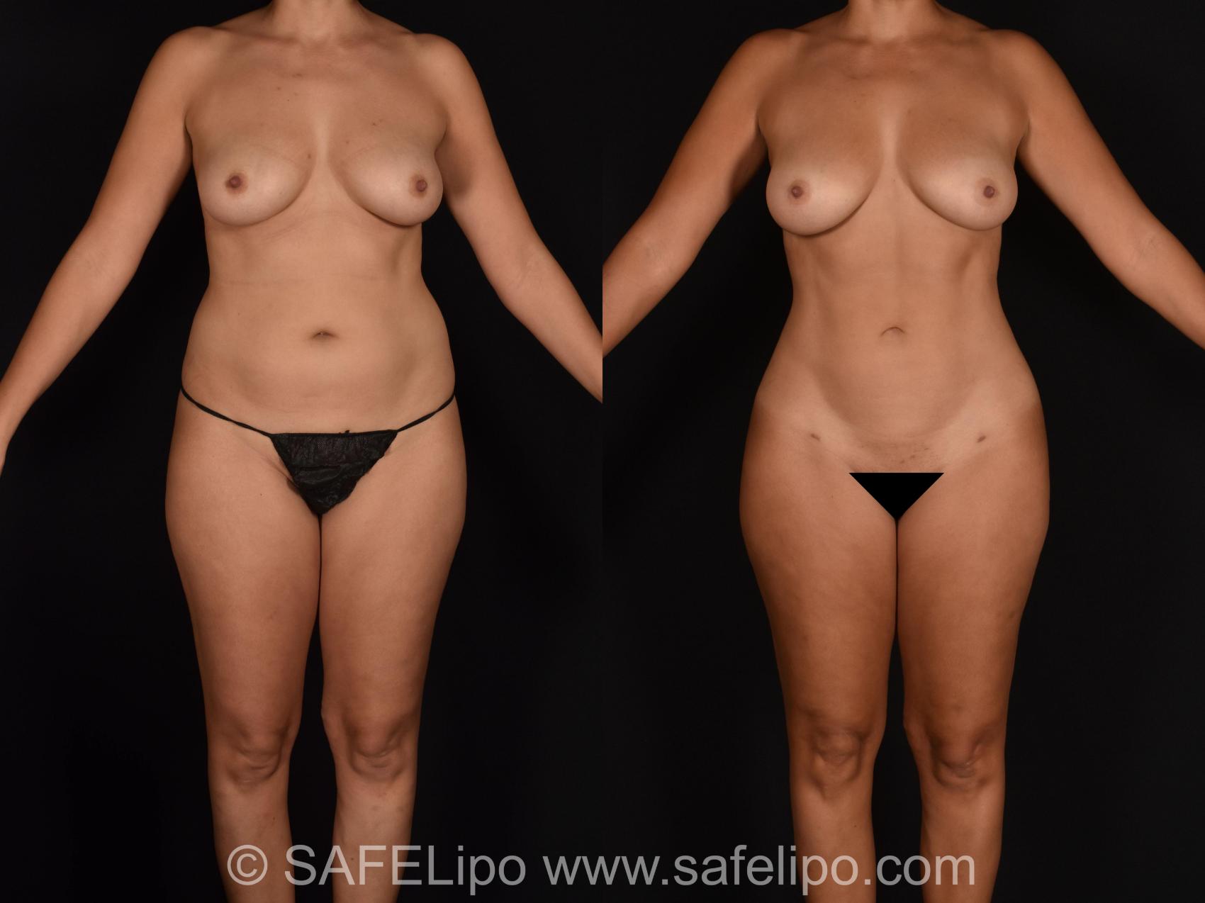 SAFELipo®360 Case 678 Before & After View #1 | SAFELipo®