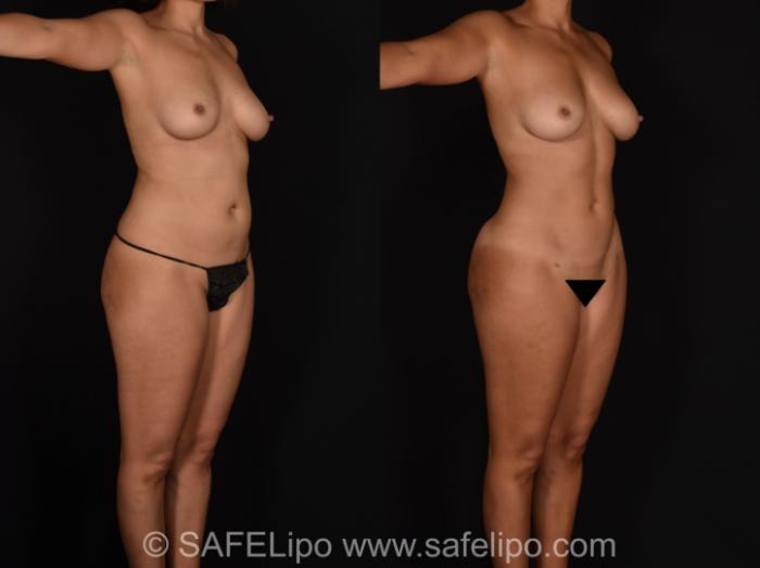 SAFELipo®360 Case 678 Before & After View #2 | SAFELipo®