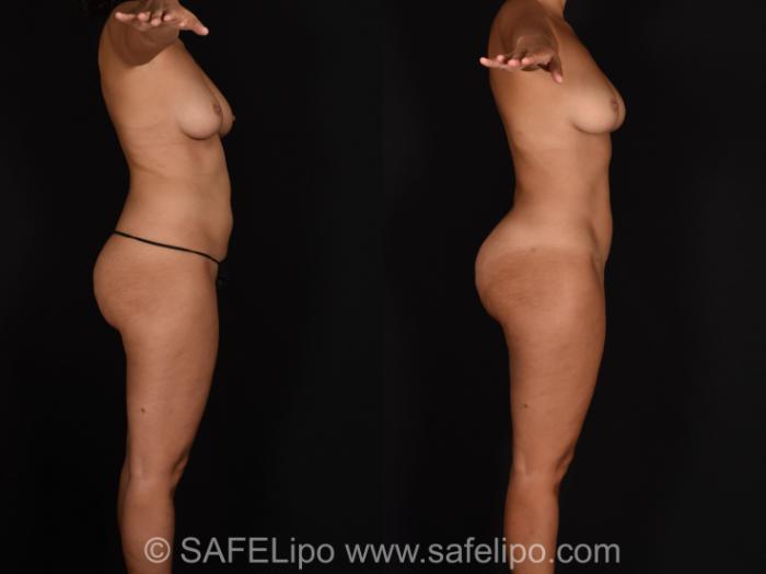 SAFELipo®360 Case 678 Before & After View #3 | SAFELipo®