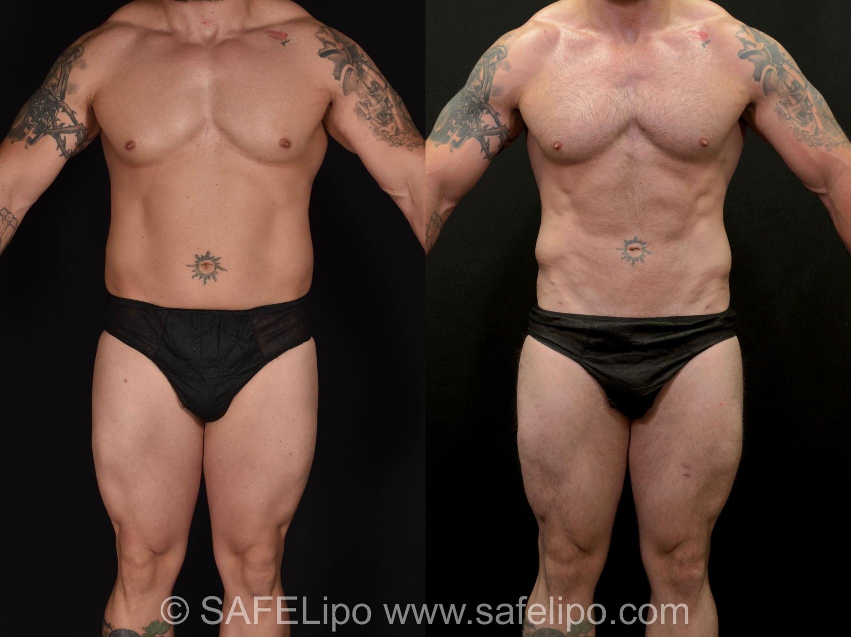 SAFELipo®360 Case 728 Before & After View #1 | SAFELipo®
