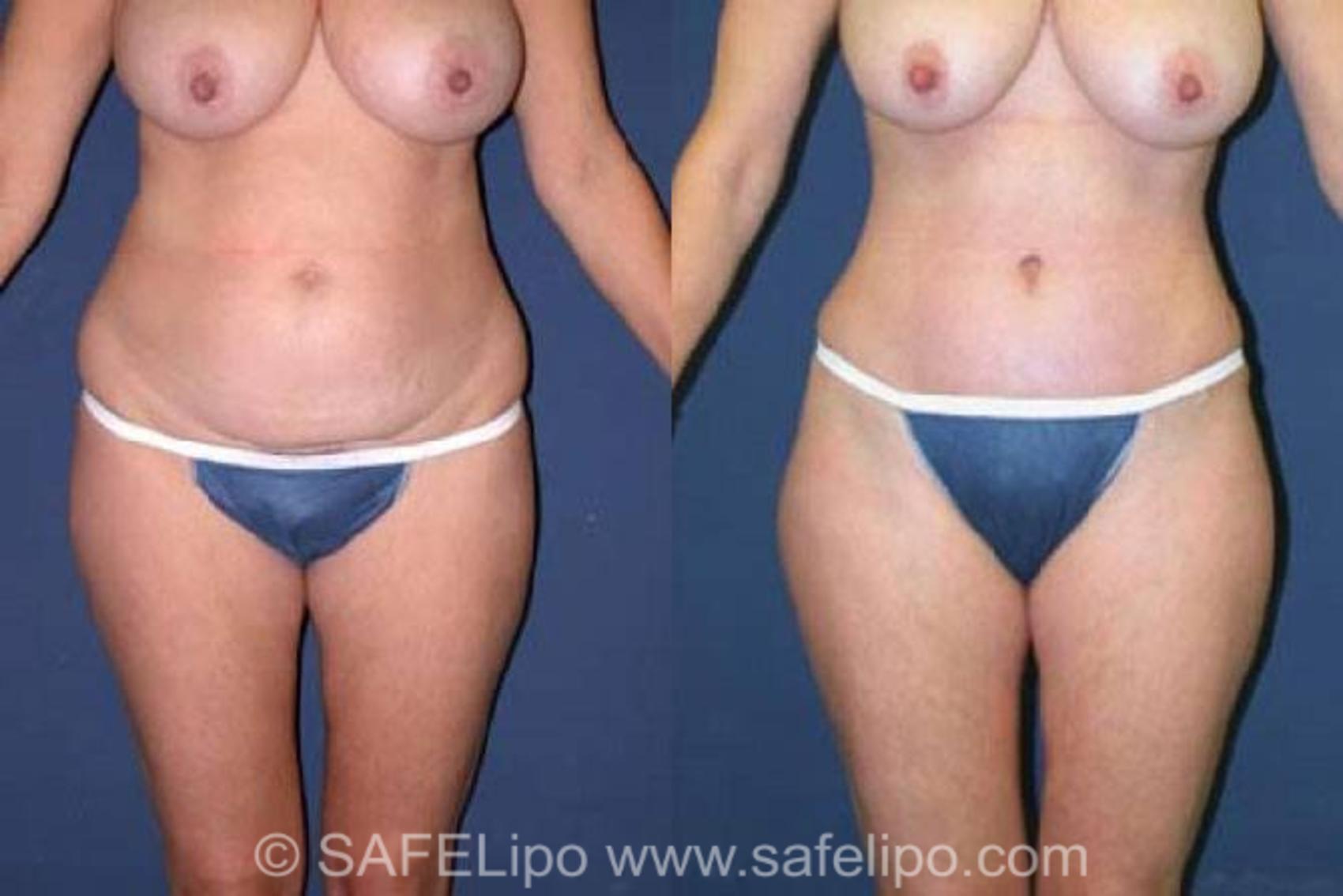 SAFELipo®360 Case 75 Before & After View #1 | SAFELipo®