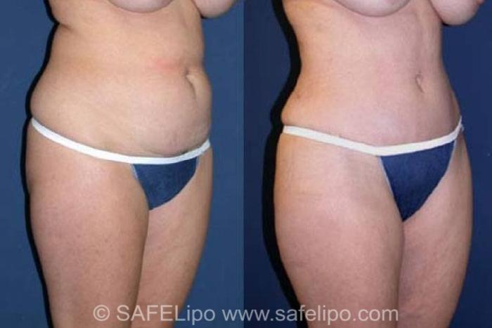 SAFELipoHD® Case 75 Before & After View #2 | SAFELipo®