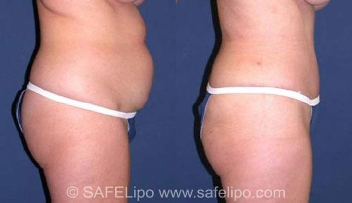 SAFELipoHD® Case 75 Before & After View #3 | SAFELipo®