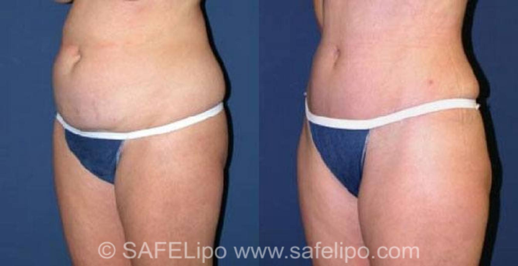 SAFELipoHD® Case 75 Before & After View #4 | SAFELipo®