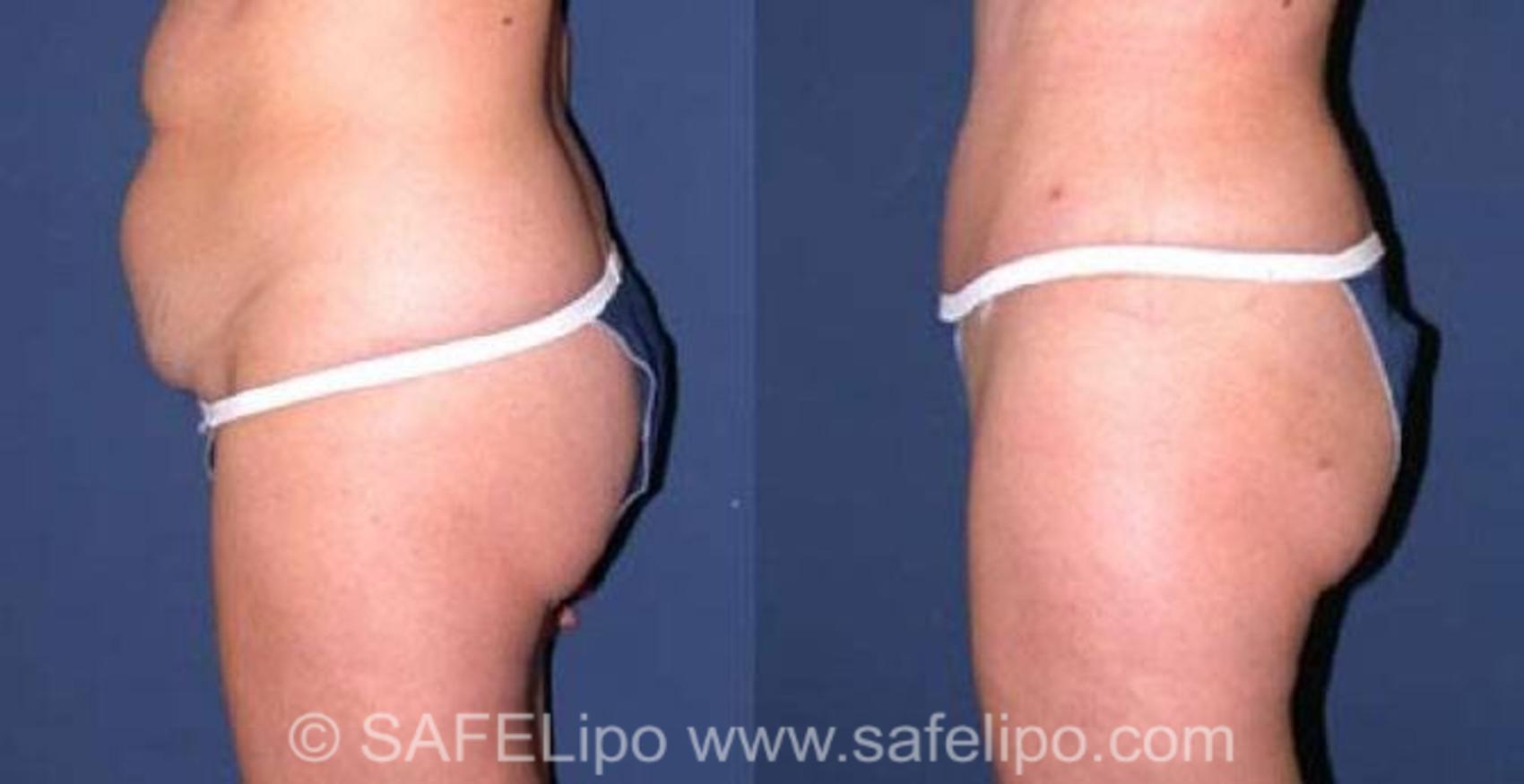 SAFELipoHD® Case 75 Before & After View #5 | SAFELipo®