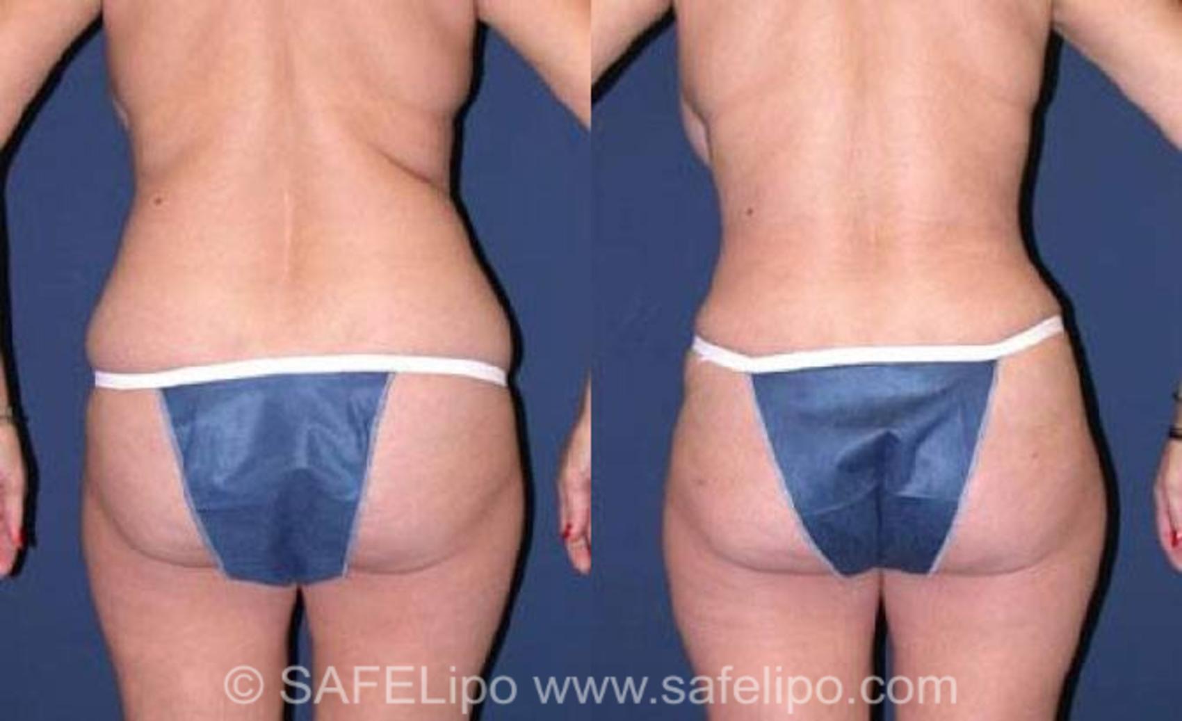 SAFELipoHD® Case 75 Before & After View #6 | SAFELipo®