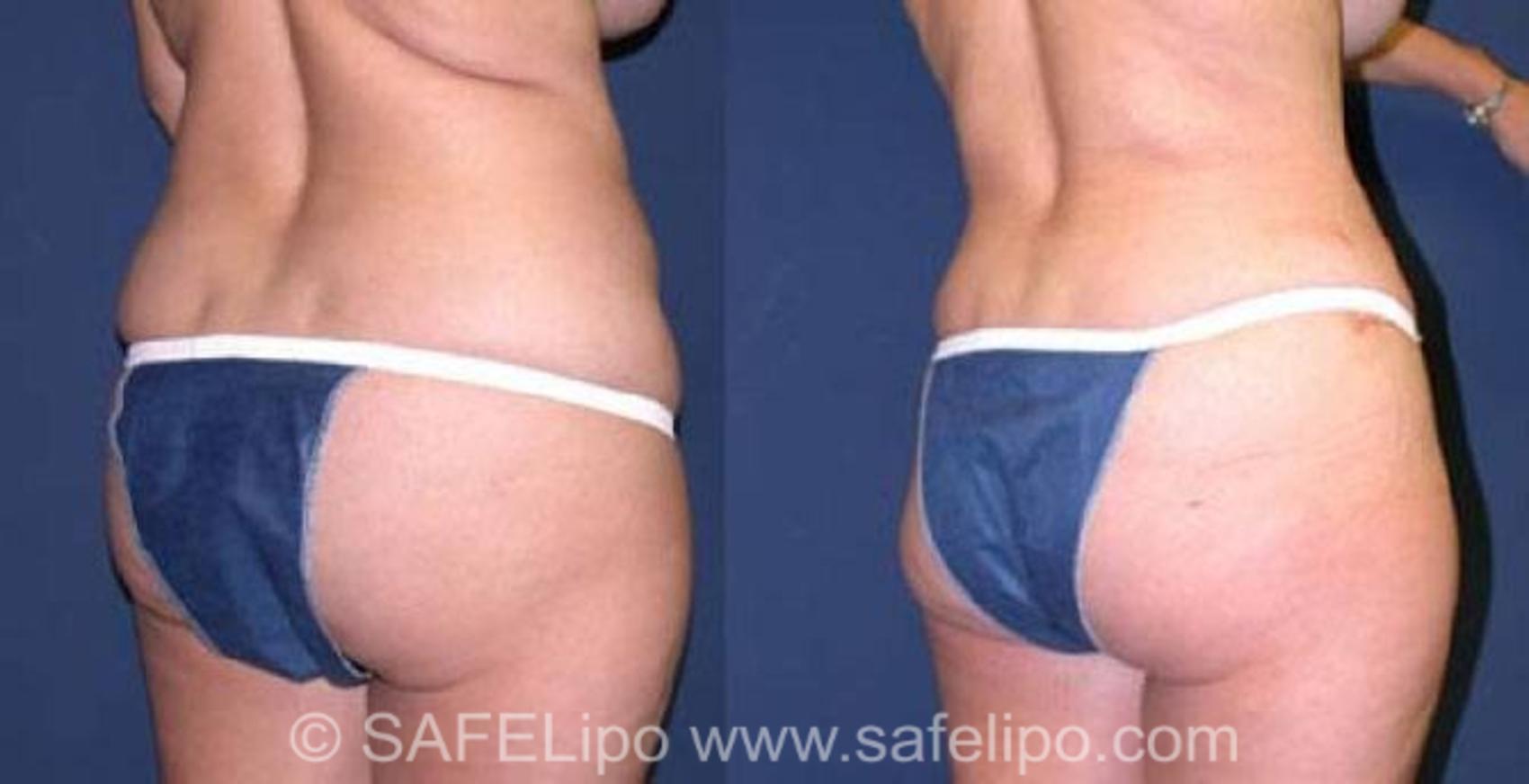 SAFELipoHD® Case 75 Before & After View #7 | SAFELipo®