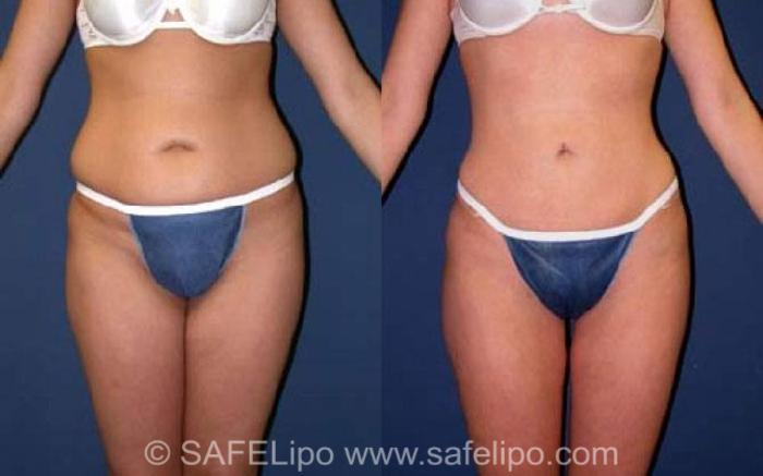 SAFELipo®360 Case 76 Before & After View #1 | SAFELipo®