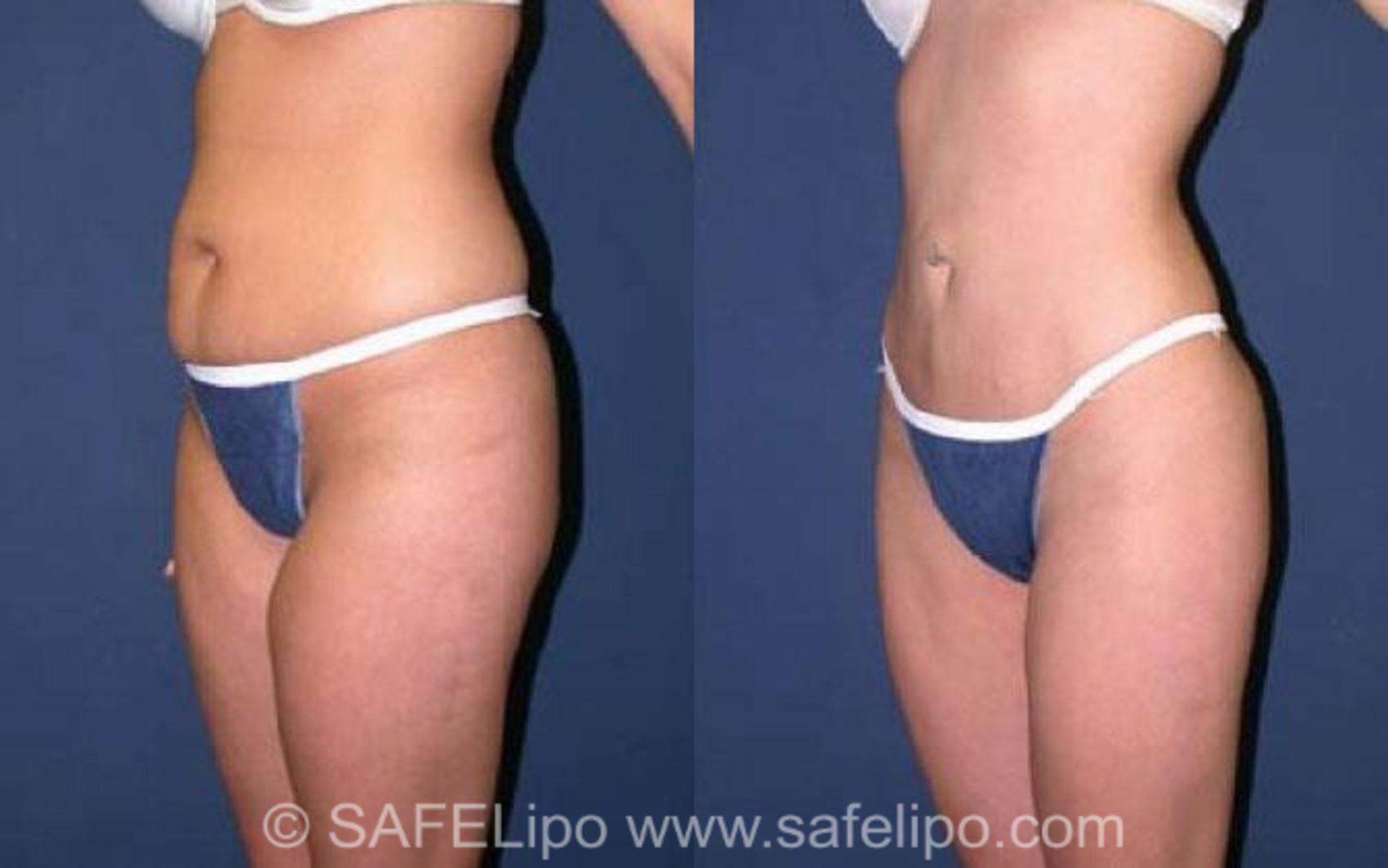 SAFELipoHD® Case 76 Before & After View #2 | SAFELipo®