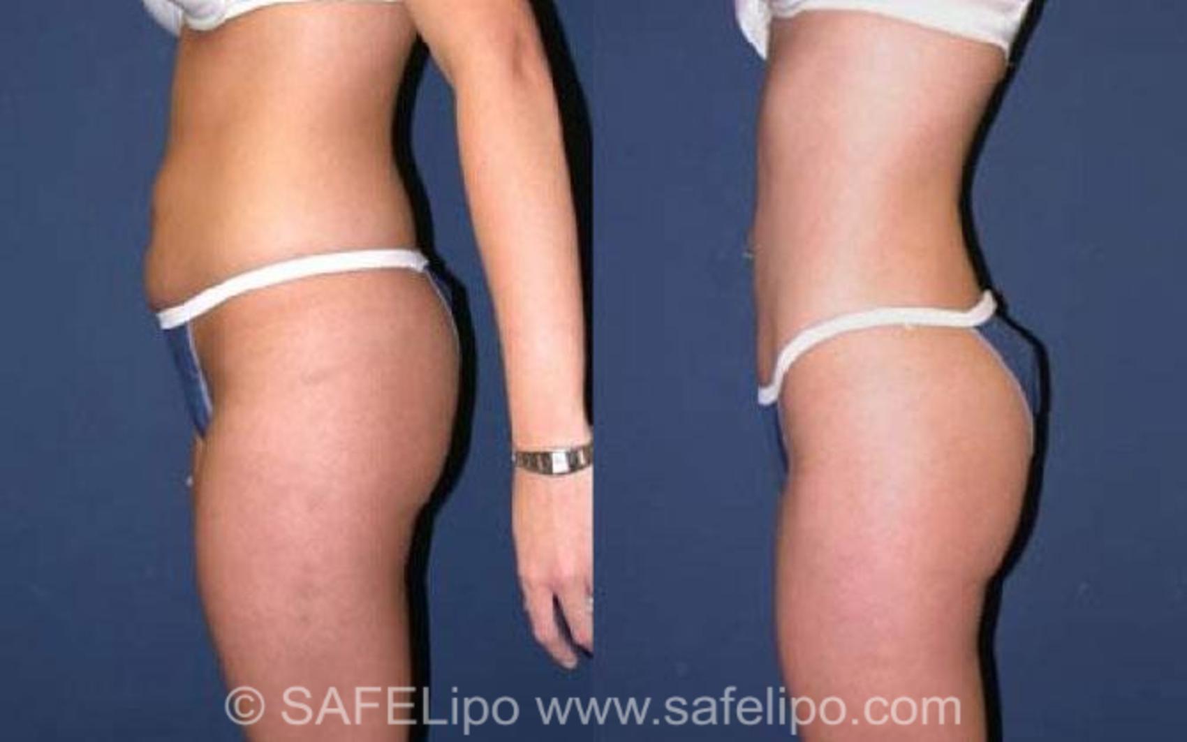 SAFELipoHD® Case 76 Before & After View #3 | SAFELipo®