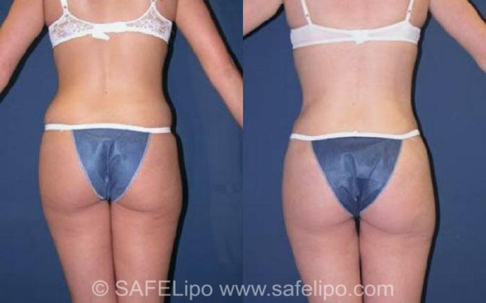 SAFELipo®360 Case 76 Before & After View #4 | SAFELipo®