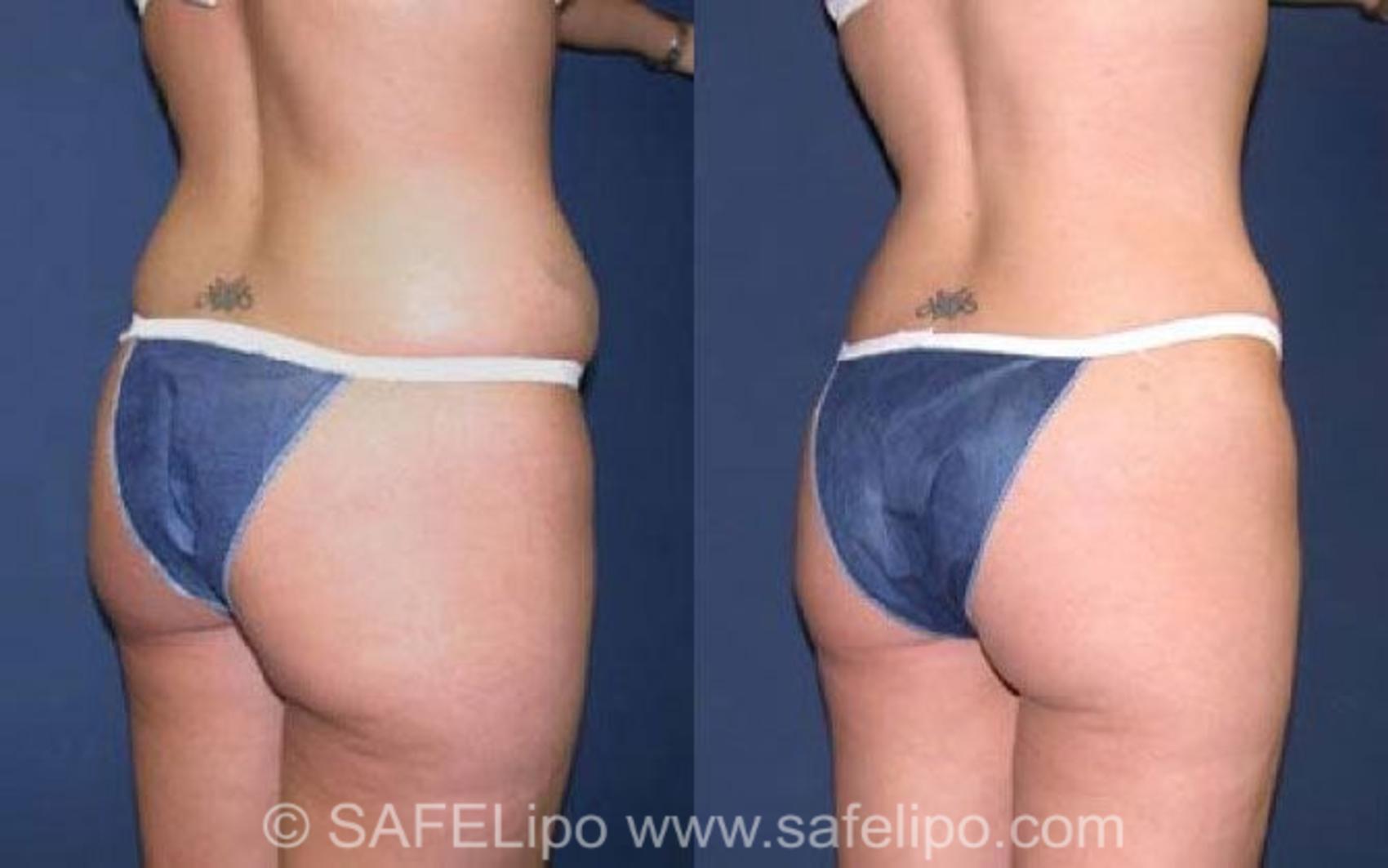 SAFELipo®360 Case 76 Before & After View #5 | SAFELipo®