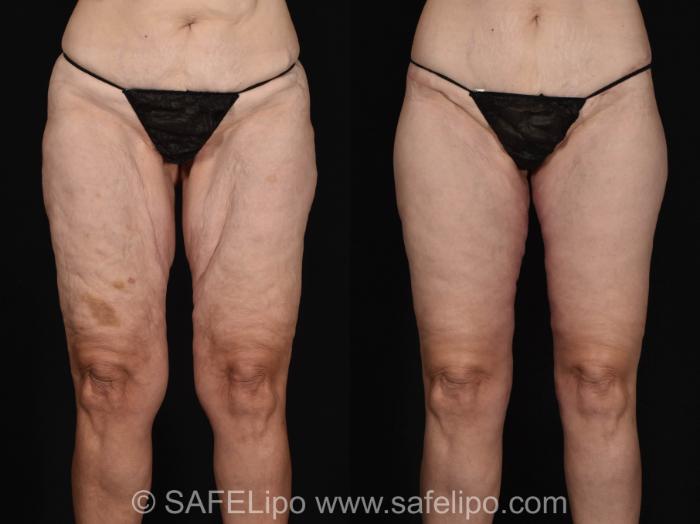 Thigh Lift Front Photo, Shreveport, Louisiana, The Wall Center for Plastic Surgery, Case 1015