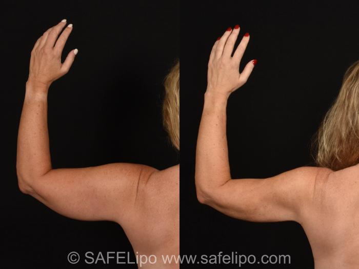 SAFELipoHD® Case 1027 Before & After Left Side | SAFELipo®