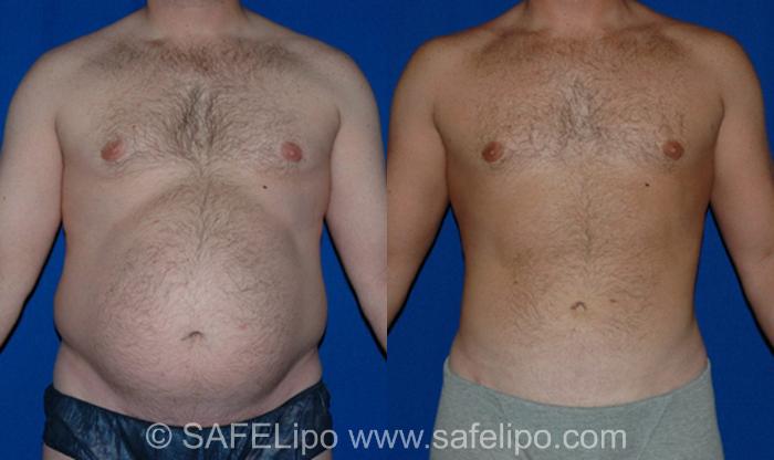 SAFELipoHD® Case 11 Before & After View #1 | SAFELipo®