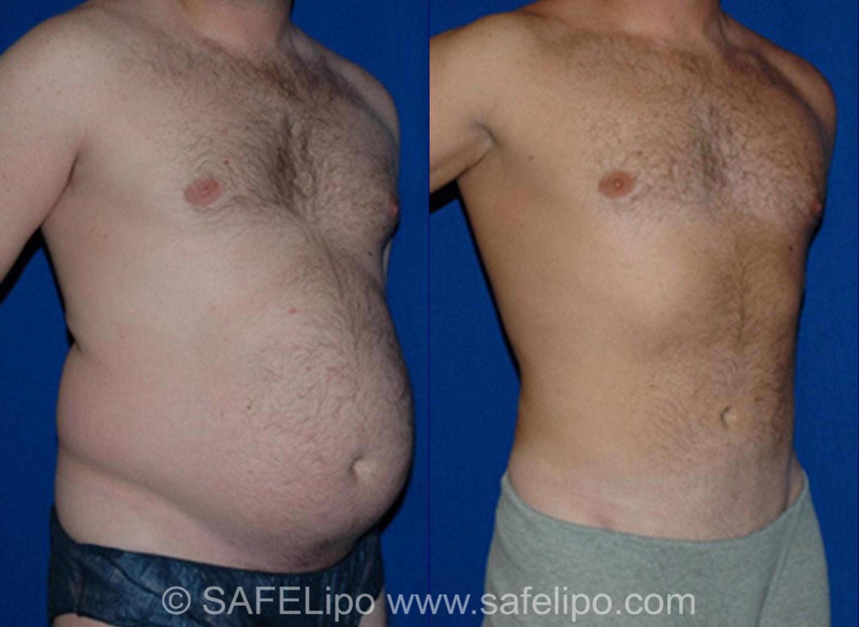 SAFELipoHD® Case 11 Before & After View #2 | SAFELipo®