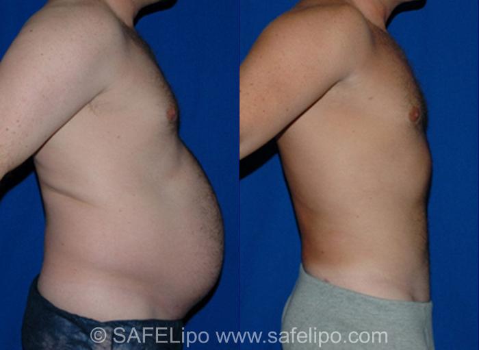 SAFELipoHD® Case 11 Before & After View #3 | SAFELipo®