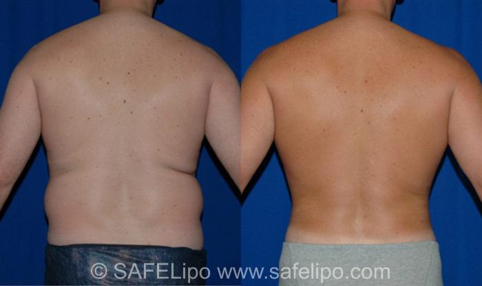 SAFELipoHD® Case 11 Before & After View #4 | SAFELipo®