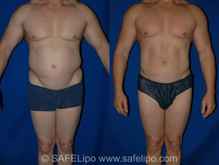 SAFELipoHD® Case 12 Before & After View #1 | SAFELipo®