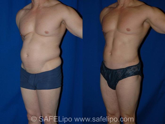 SAFELipoHD® Case 12 Before & After View #2 | SAFELipo®