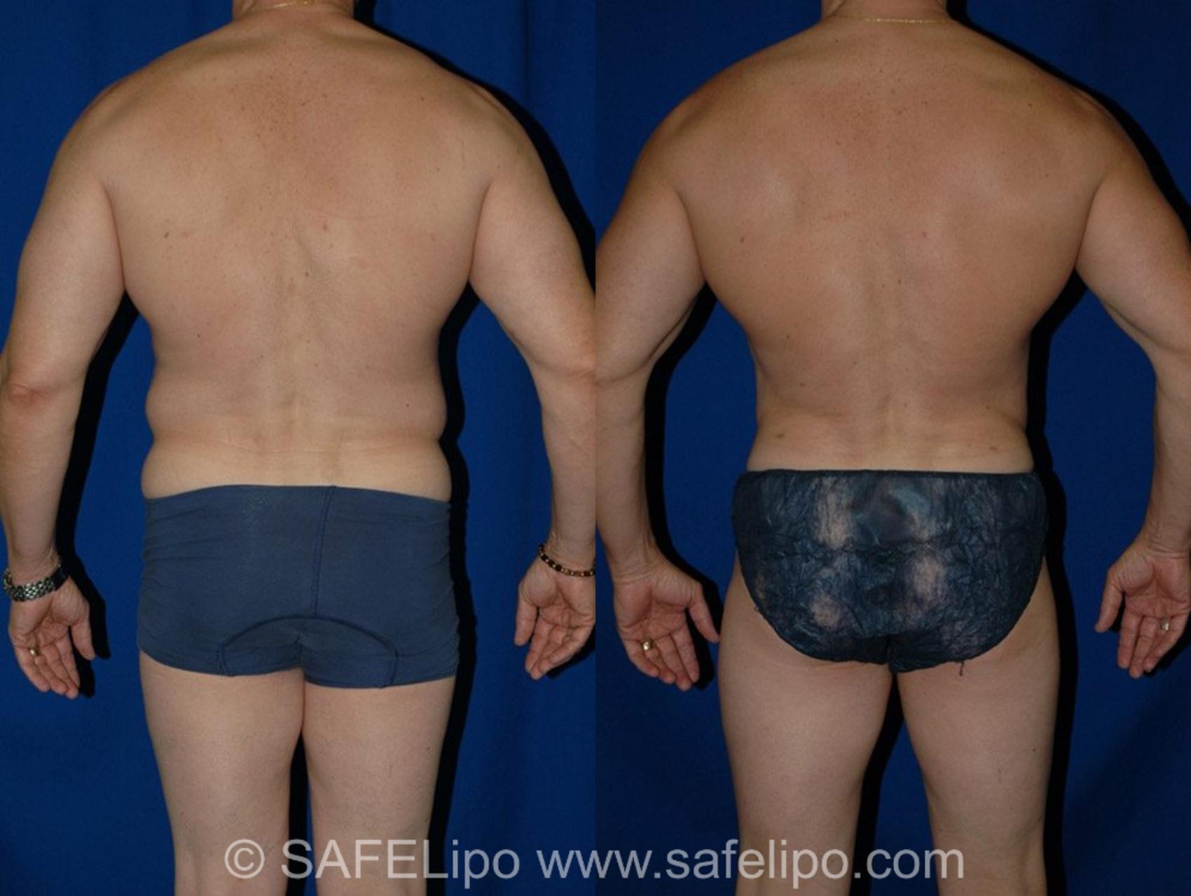 SAFELipoHD® Case 12 Before & After View #4 | SAFELipo®