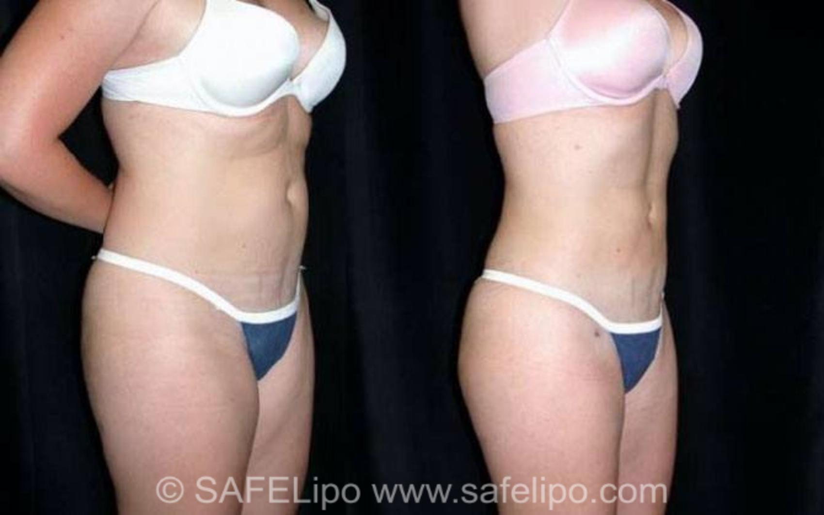 SAFELipoHD® Case 138 Before & After View #2 | SAFELipo®