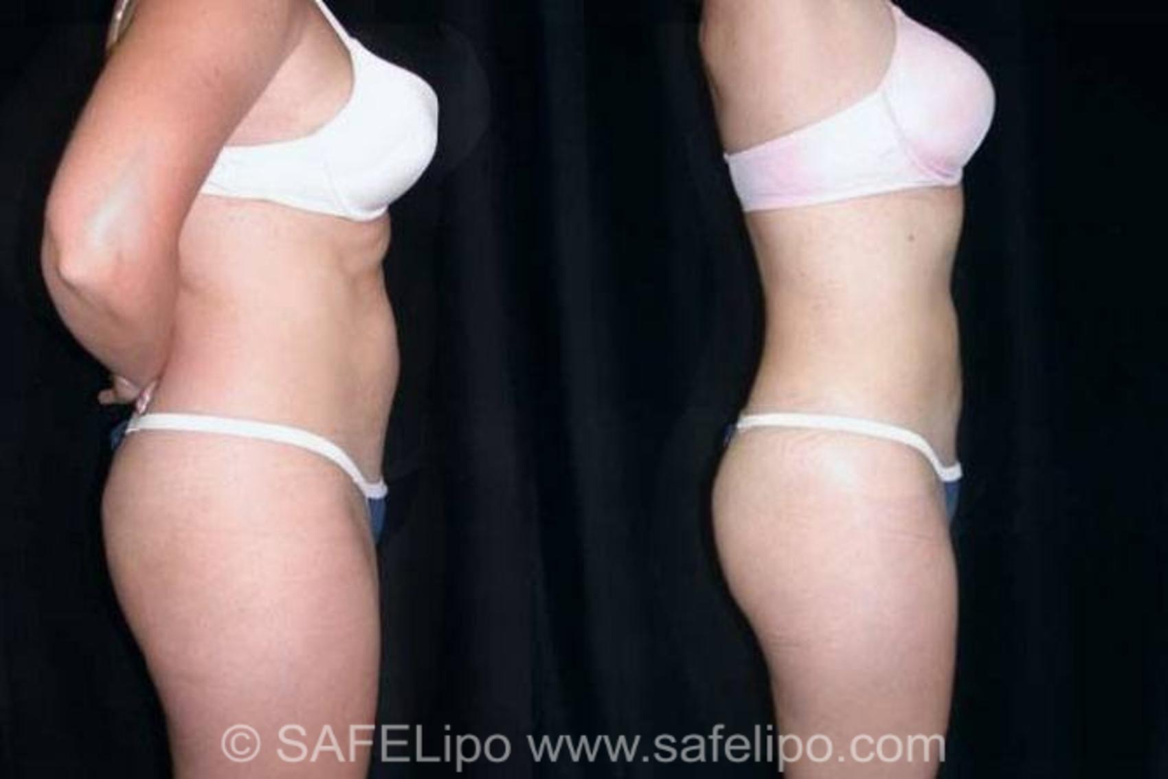SAFELipoHD® Case 138 Before & After View #3 | SAFELipo®