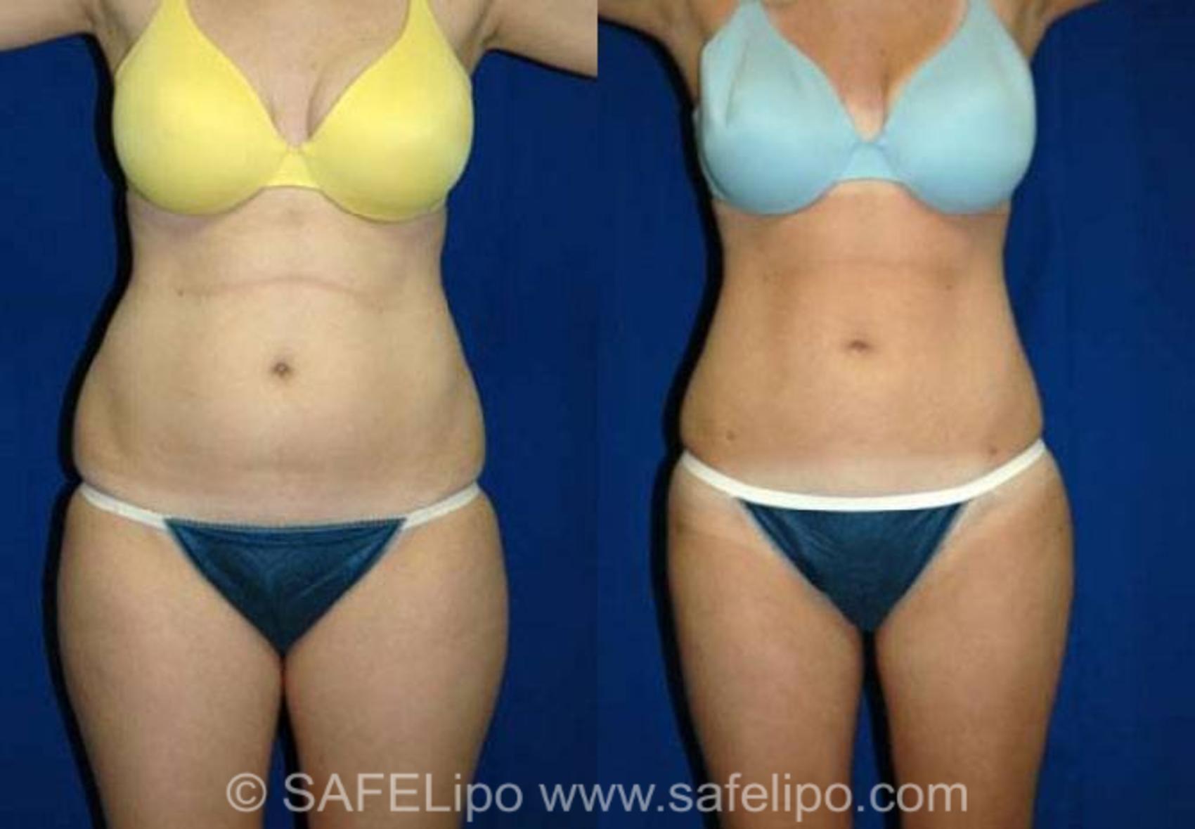 SAFELipoHD® Case 141 Before & After View #1 | SAFELipo®