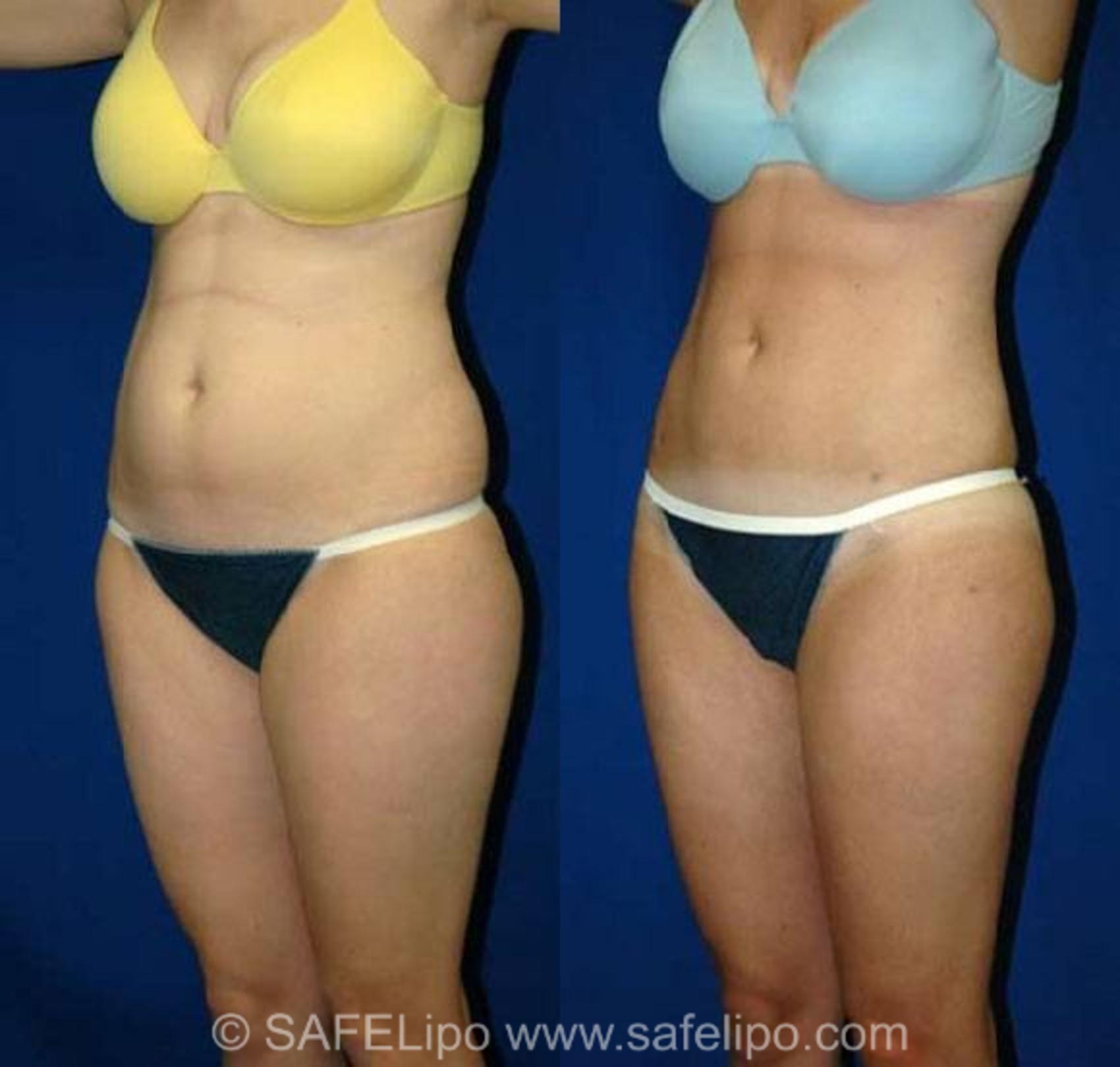 SAFELipoHD® Case 141 Before & After View #2 | SAFELipo®