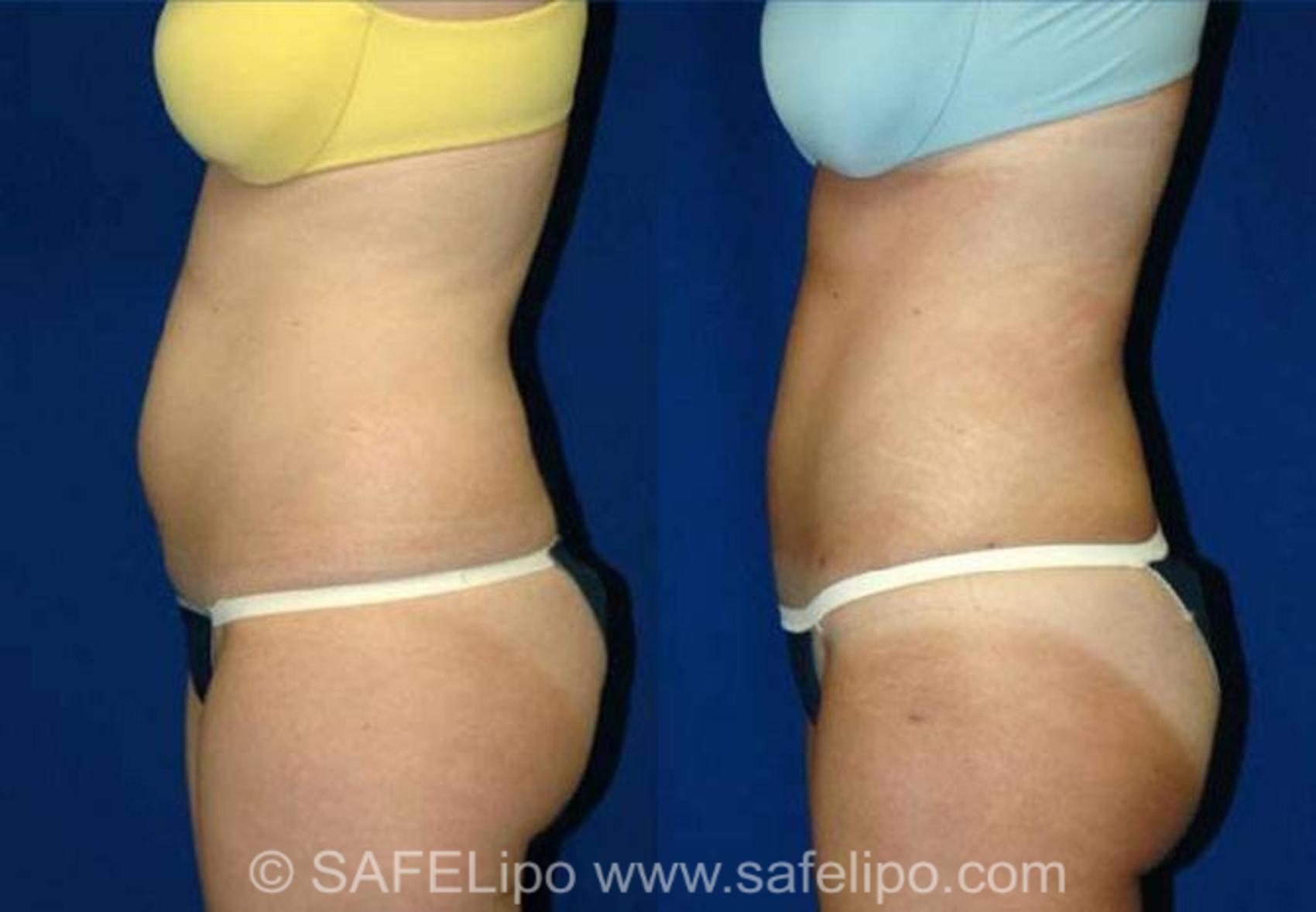 SAFELipoHD® Case 141 Before & After View #3 | SAFELipo®