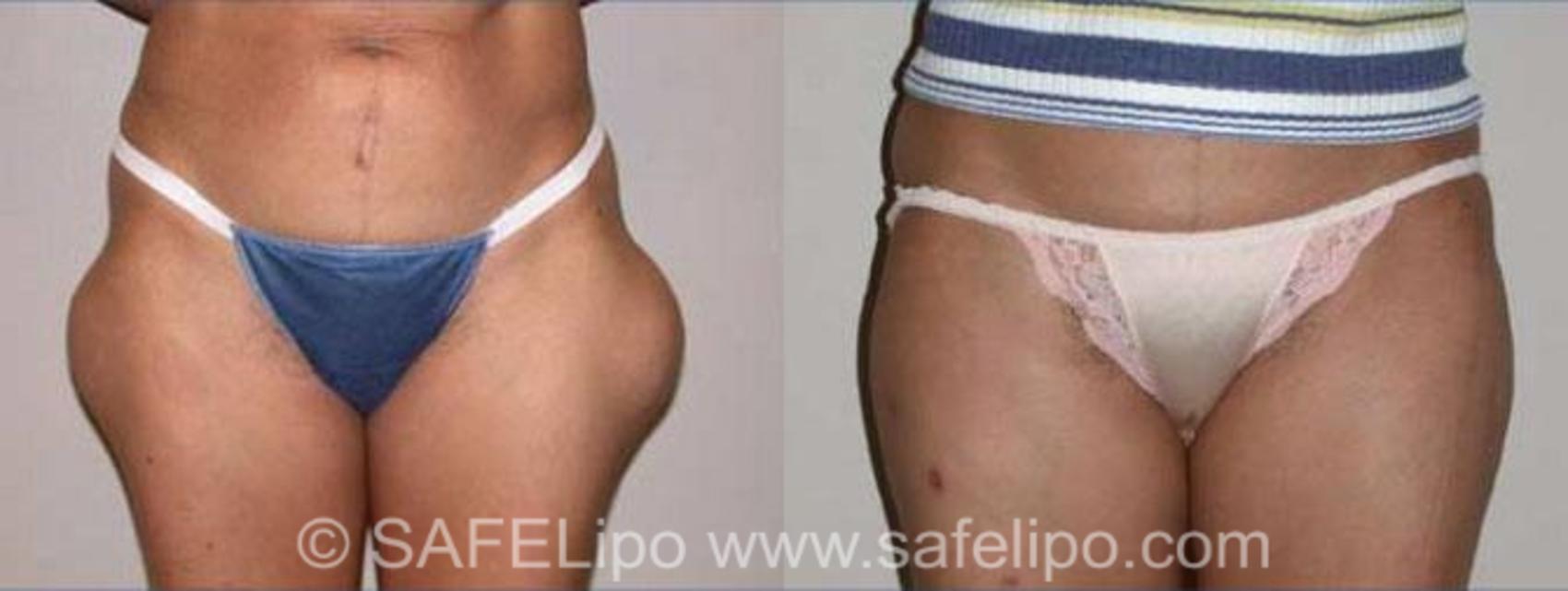 SAFELipoHD® Case 142 Before & After View #1 | SAFELipo®