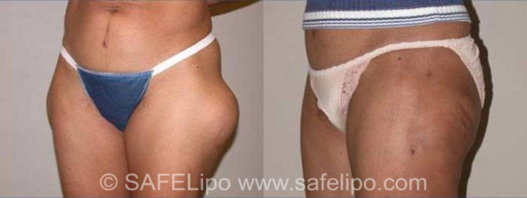 SAFELipoHD® Case 142 Before & After View #2 | SAFELipo®
