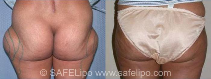 SAFELipoHD® Case 142 Before & After View #3 | SAFELipo®